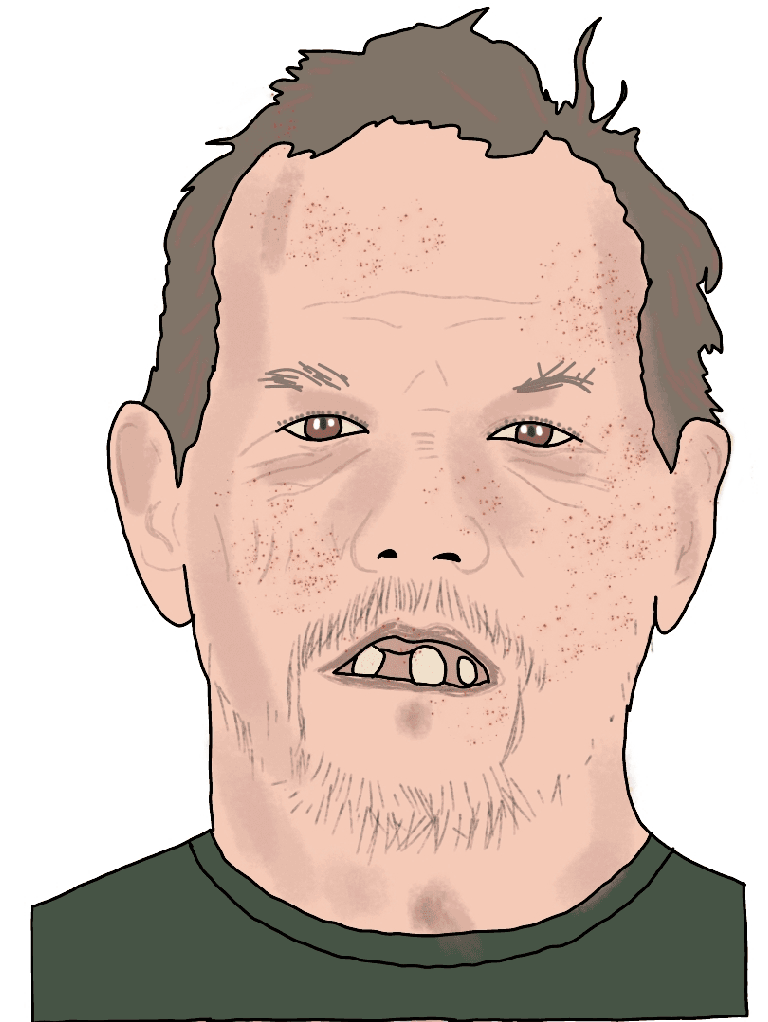 A portrait of a man with bad hair, missing teeth, a skin condition, and in need of a shave.